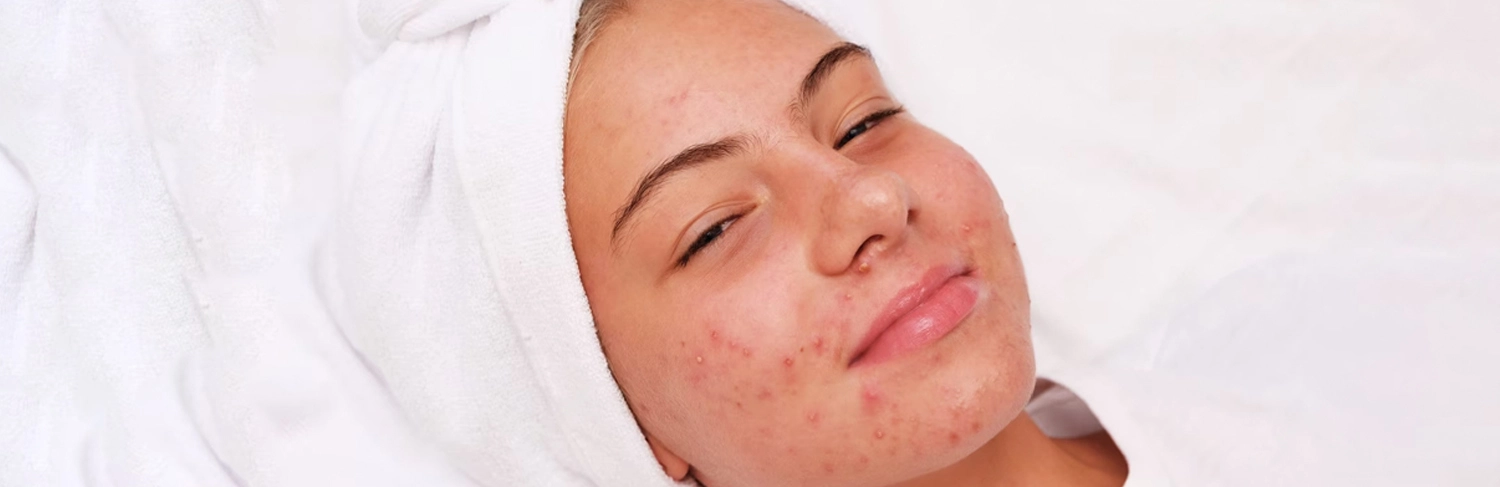 Aluer-Acne Treatment In Kerala