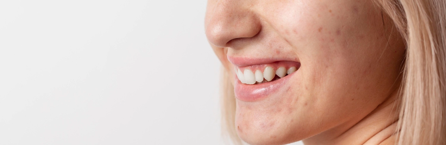 Aluer-Acne Scar Treatment In Kerala