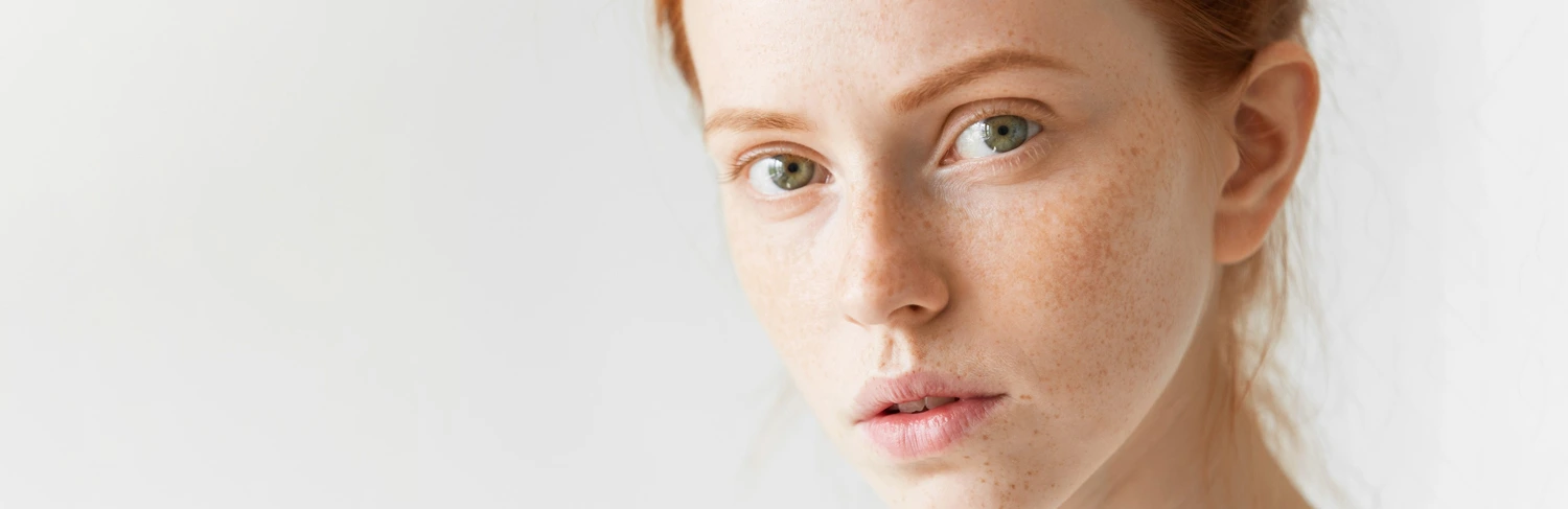 Aluer-Melasma Treatment In Calicut