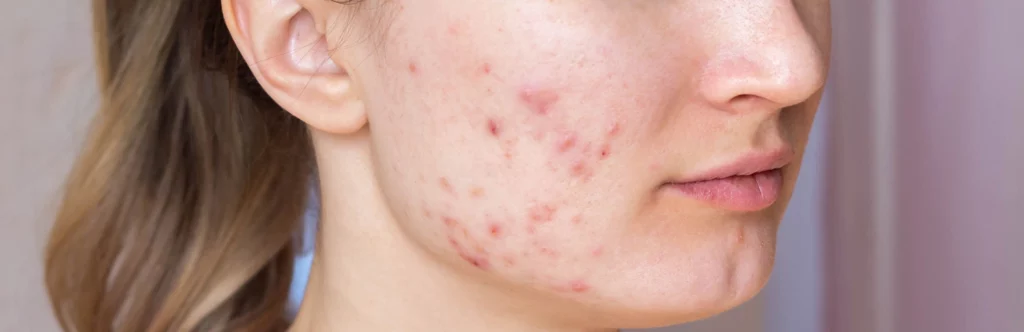 Aluer -Acne treatment in kerala