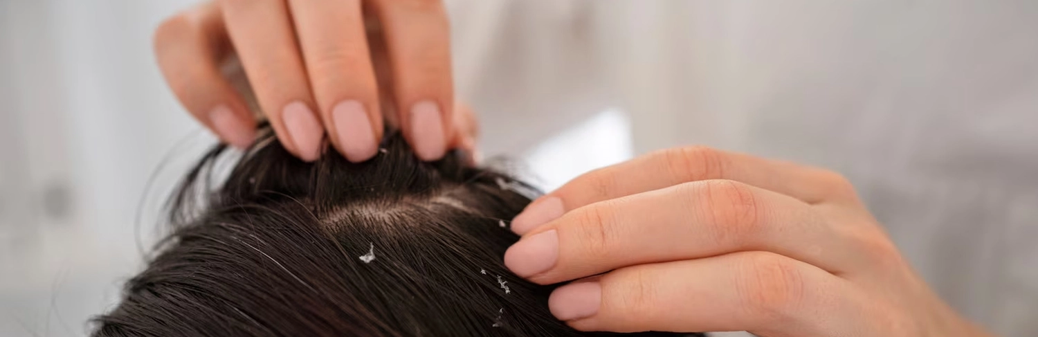 Aluer skin clinic -Dandruff treatment in Calicut