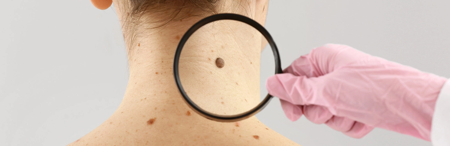 Aluer-Best skin clinic in calicut