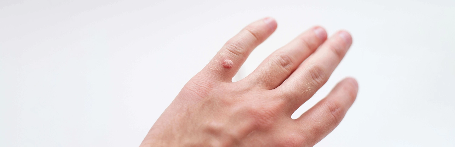 Aluer-Skin clinic in calicut