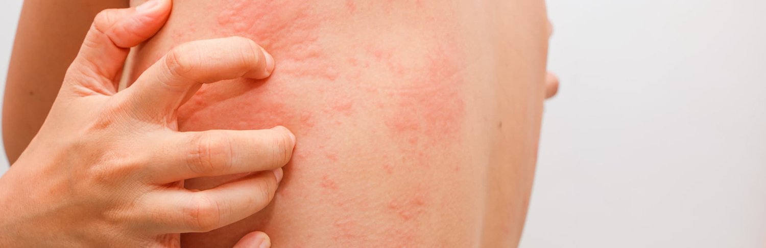 Urticaria treatment