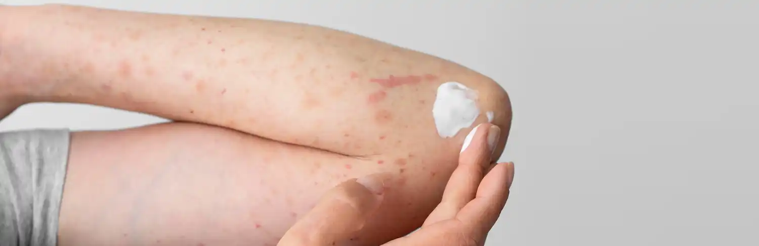 Eczema During Pregnancy and Breastfeeding: What You Need to Know